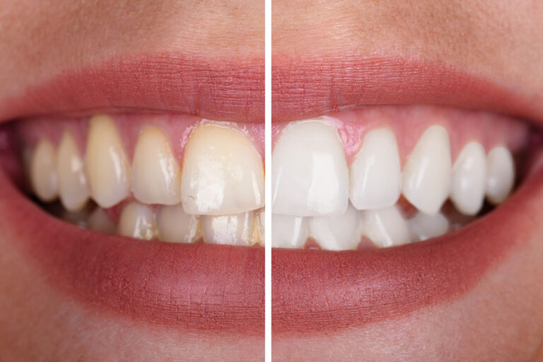 Zähne vor und nach der Aufhellung